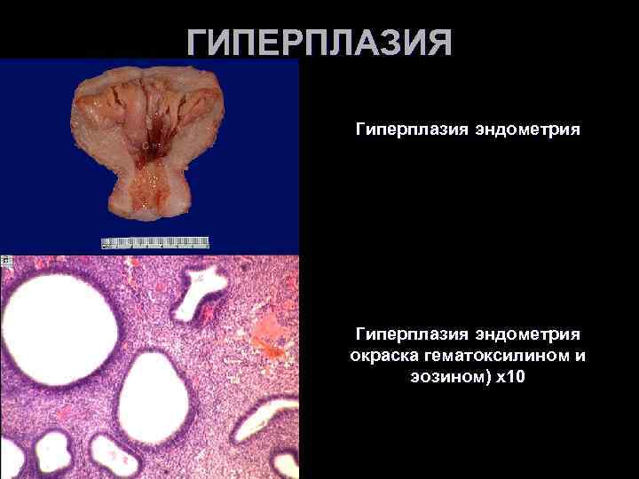 ГИПЕРПЛАЗИЯ Гиперплазия эндометрия окраска гематоксилином и эозином) х10 ГИПЕРПЛАЗИЯ Гиперплазия эндометрия окраска гематоксилином и эозином) х10
