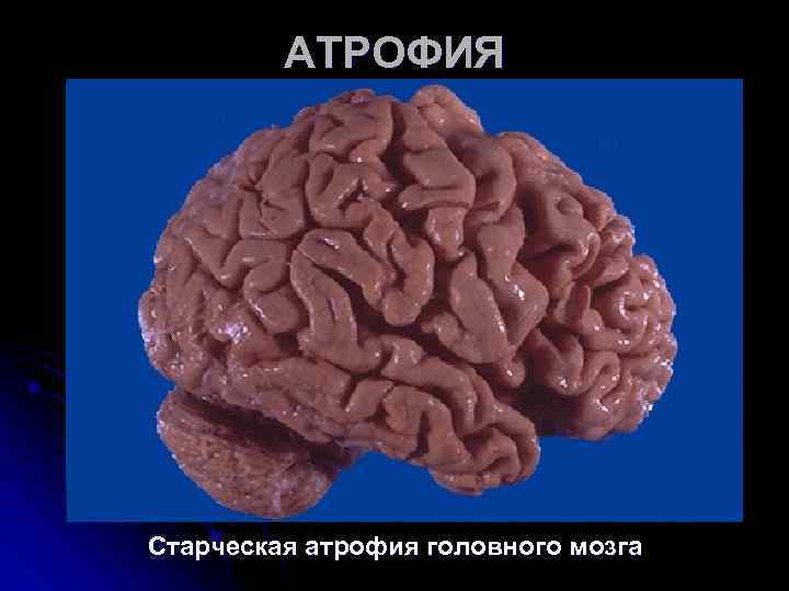 АТРОФИЯ Старческая атрофия головного мозга АТРОФИЯ Старческая атрофия головного мозга