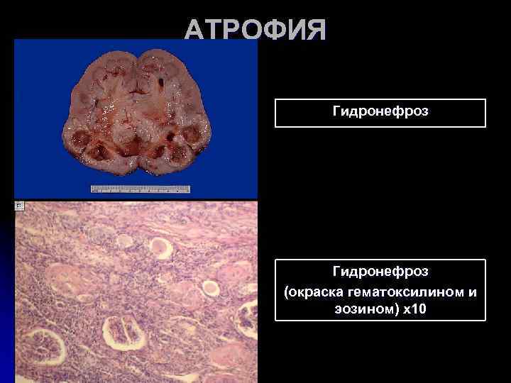 АТРОФИЯ Гидронефроз (окраска гематоксилином и эозином) х10 АТРОФИЯ Гидронефроз (окраска гематоксилином и эозином) х10