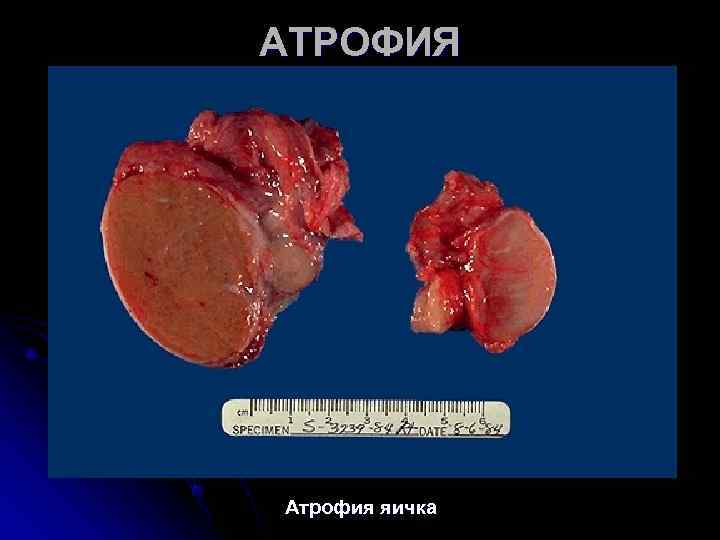АТРОФИЯ Атрофия яичка АТРОФИЯ Атрофия яичка