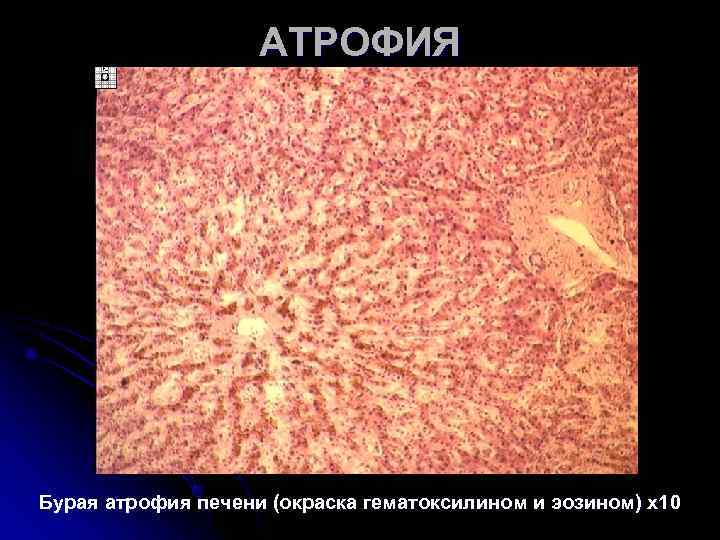 АТРОФИЯ Бурая атрофия печени (окраска гематоксилином и эозином) х10 АТРОФИЯ Бурая атрофия печени (окраска гематоксилином и эозином) х10