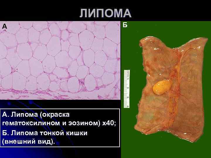 ЛИПОМА А Б А. Липома ЛИПОМА А Б А. Липома