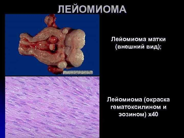 ЛЕЙОМИОМА Лейомиома матки (внешний вид); Лейомиома (окраска гематоксилином ЛЕЙОМИОМА Лейомиома матки (внешний вид); Лейомиома (окраска гематоксилином