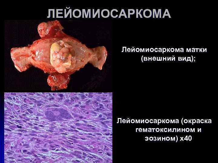 ЛЕЙОМИОСАРКОМА Лейомиосаркома матки (внешний вид); Лейомиосаркома (окраска ЛЕЙОМИОСАРКОМА Лейомиосаркома матки (внешний вид); Лейомиосаркома (окраска