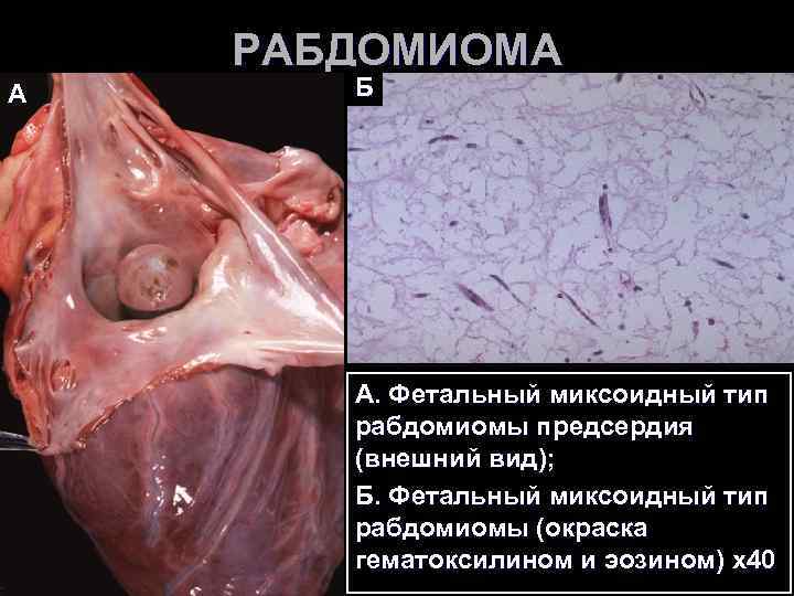 РАБДОМИОМА А Б А. Фетальный миксоидный тип рабдомиомы предсердия РАБДОМИОМА А Б А. Фетальный миксоидный тип рабдомиомы предсердия