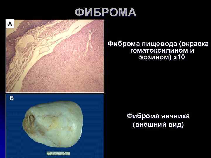 ФИБРОМА А Фиброма пищевода (окраска гематоксилином и ФИБРОМА А Фиброма пищевода (окраска гематоксилином и