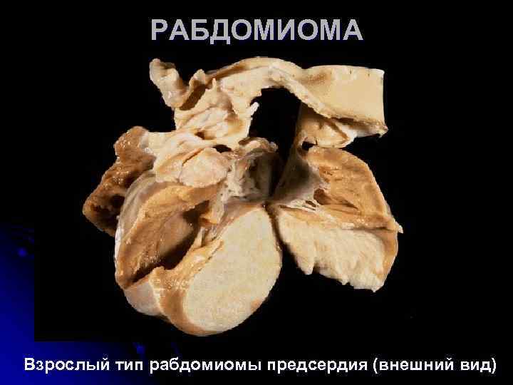 РАБДОМИОМА Взрослый тип рабдомиомы предсердия (внешний вид) РАБДОМИОМА Взрослый тип рабдомиомы предсердия (внешний вид)