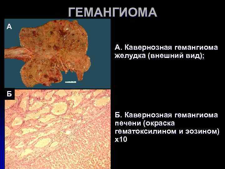 ГЕМАНГИОМА А А. Кавернозная гемангиома желудка (внешний вид); Б ГЕМАНГИОМА А А. Кавернозная гемангиома желудка (внешний вид); Б