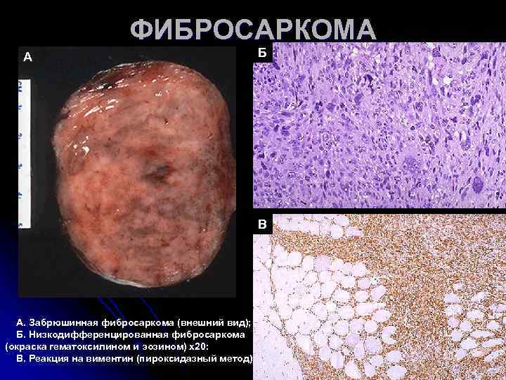 ФИБРОСАРКОМА А Б ФИБРОСАРКОМА А Б