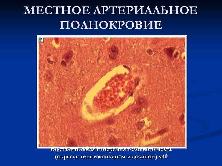 МЕСТНОЕ АРТЕРИАЛЬНОЕ ПОЛНОКРОВИЕ  Воспалительная гиперемия головного мозга (окраска гематоксилином и эозином) х40 
