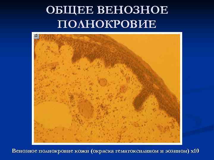   ОБЩЕЕ ВЕНОЗНОЕ   ПОЛНОКРОВИЕ Венозное полнокровие кожи (окраска гематоксилином и эозином)