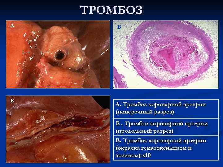   ТРОМБОЗ А  В Б  А. Тромбоз коронарной артерии  (поперечный