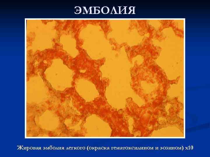     ЭМБОЛИЯ Жировая эмболия легкого (окраска гематоксилином и эозином) х10 