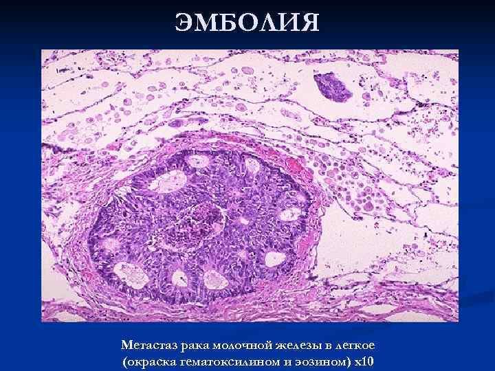   ЭМБОЛИЯ Метастаз рака молочной железы в легкое (окраска гематоксилином и эозином) х10