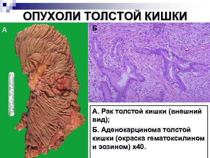 Рак толстой кишки картинки