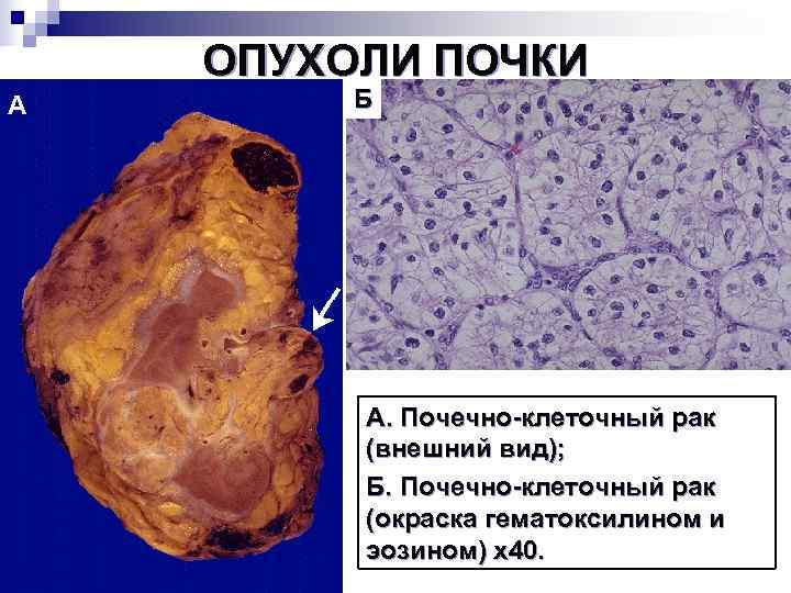 Опухоли презентация патология