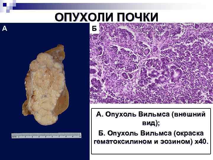   ОПУХОЛИ ПОЧКИ А  Б   А. Опухоль Вильмса (внешний 