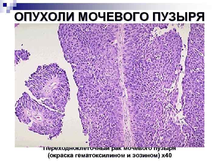 ОПУХОЛИ МОЧЕВОГО ПУЗЫРЯ  Переходноклеточный рак мочевого пузыря (окраска гематоксилином и эозином) х40 