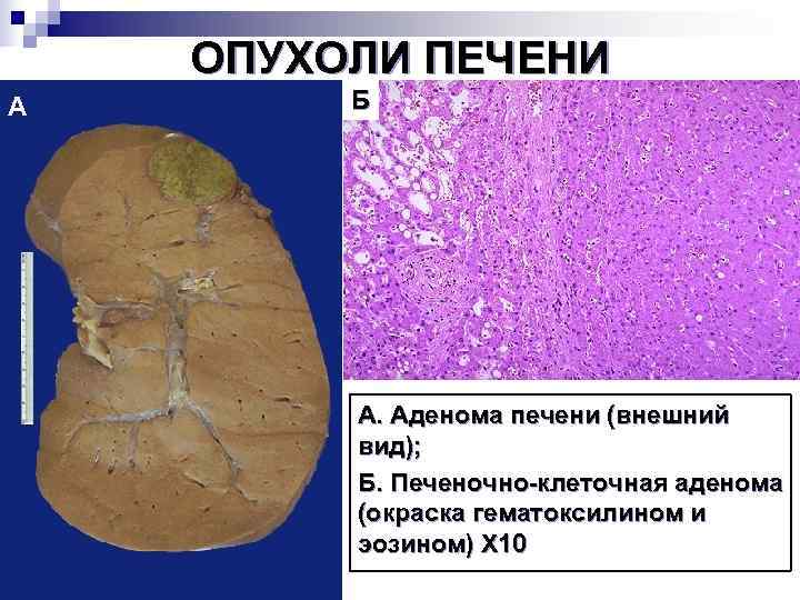   ОПУХОЛИ ПЕЧЕНИ А  Б   А. Аденома печени (внешний 