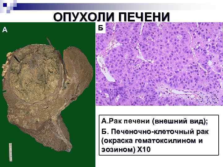   ОПУХОЛИ ПЕЧЕНИ А  Б   А. Рак печени (внешний вид);