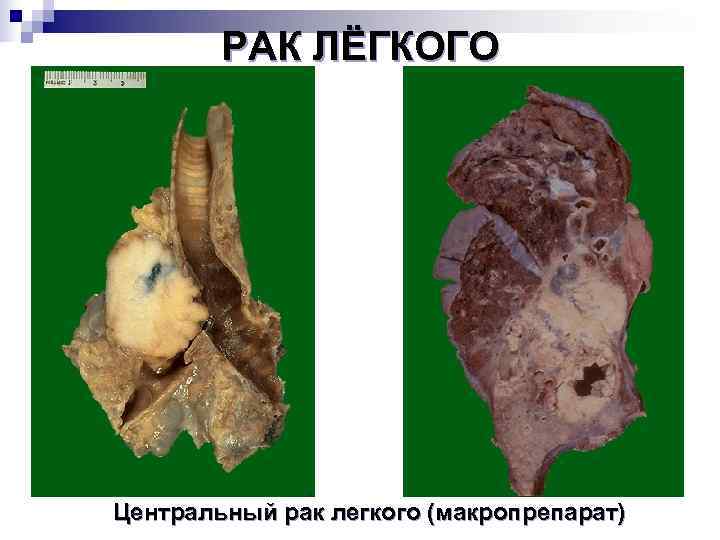 Центральный рак легкого картинки