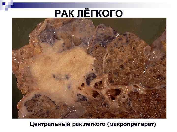   РАК ЛЁГКОГО Центральный рак легкого (макропрепарат) 