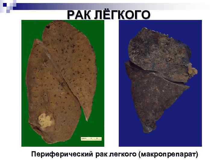   РАК ЛЁГКОГО Периферический рак легкого (макропрепарат) 
