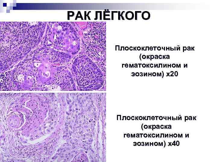 Стадии рака легких плоскоклеточный. Плоскоклеточная карцинома легкого гистология. Плоскоклеточная карцинома кожи гистология. Плоскоклеточная карцинома легкого микропрепарат. Плоскоклеточная карцинома пищевода гистология.