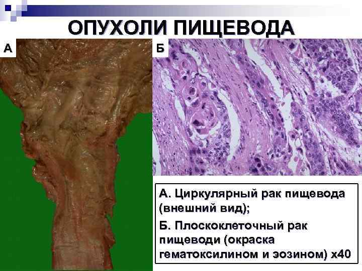   ОПУХОЛИ ПИЩЕВОДА А   Б    А. Циркулярный рак