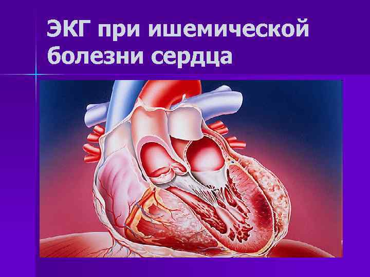 ЭКГ при ишемической болезни сердца 