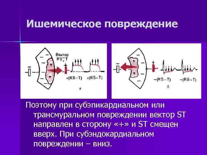 Ишемическое повреждение Поэтому при субэпикардиальном или  трансмуральном повреждении вектор ST  направлен в
