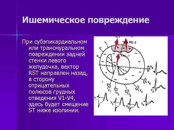 Ишемическое повреждение При субэпикардиальном  или трансмуральном  повреждении задней  стенки левого 