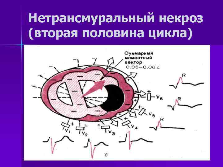 Нетрансмуральный некроз (вторая половина цикла) 