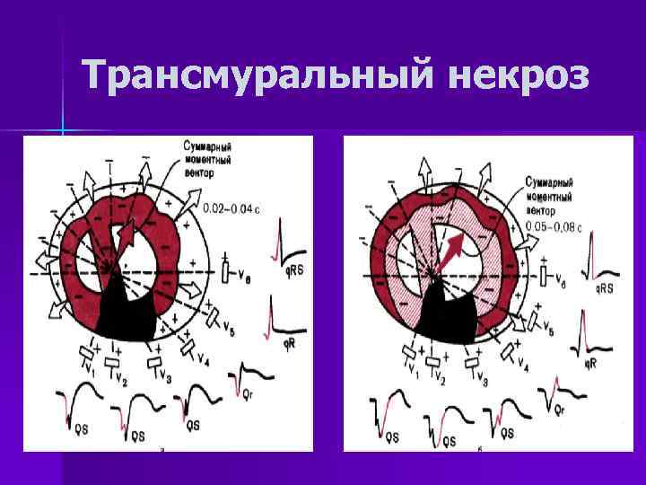Трансмуральный некроз 