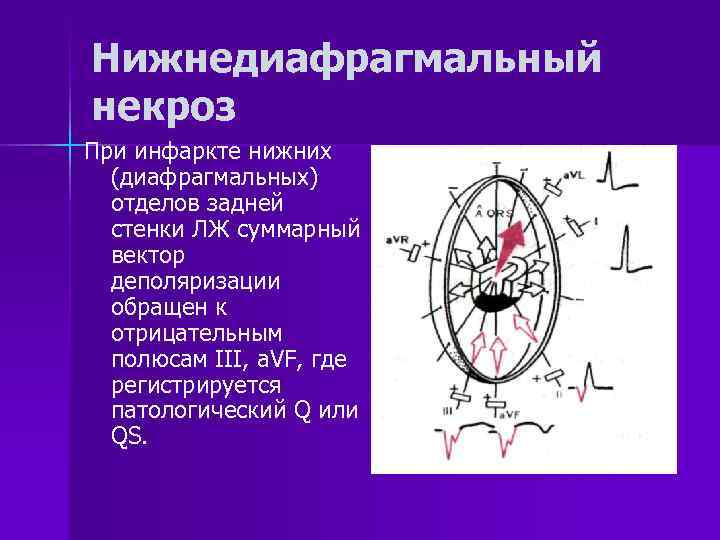Нижнедиафрагмальный некроз При инфаркте нижних  (диафрагмальных)  отделов задней  стенки ЛЖ суммарный