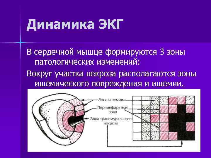Динамика ЭКГ В сердечной мышце формируются 3 зоны  патологических изменений: Вокруг участка некроза
