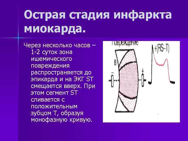 Острая стадия инфаркта миокарда. Через несколько часов –  1 -2 суток зона 