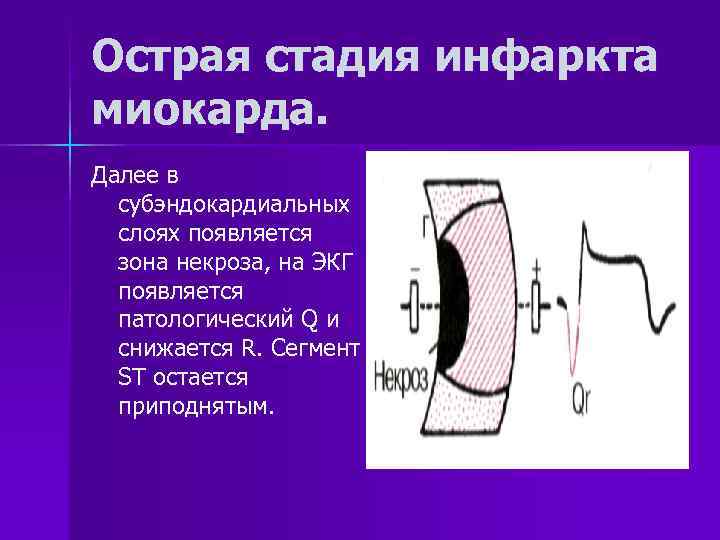 Острая стадия инфаркта миокарда. Далее в  субэндокардиальных  слоях появляется  зона некроза,