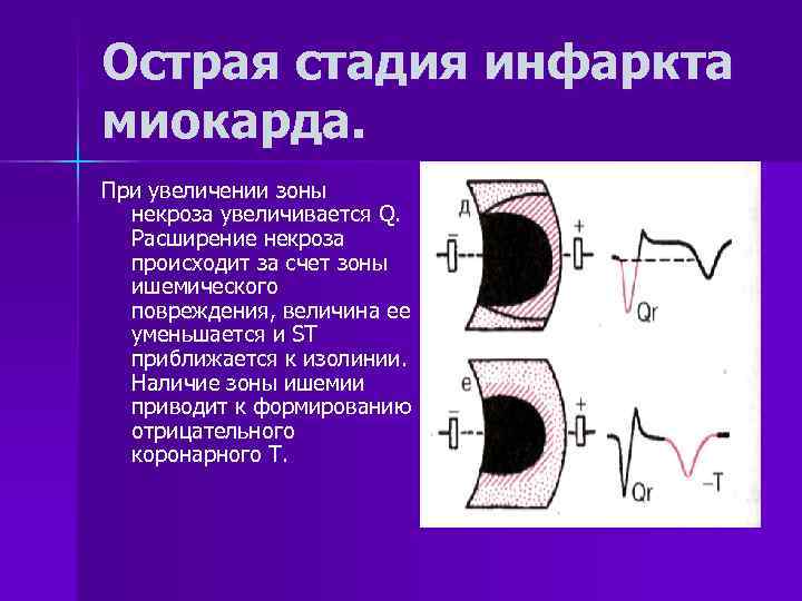 Основным экг признаком некроза сердечной мышцы является. Стадия ишемии инфаркта миокарда на ЭКГ. Зона некроза на ЭКГ при инфаркте миокарда. Острая стадия инфаркта некроз ЭКГ. Стадия повреждения инфаркта миокарда.