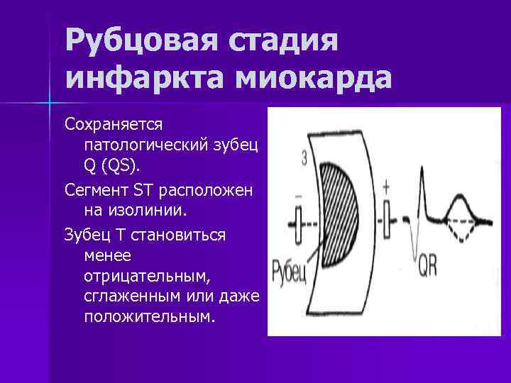 Рубцовая стадия инфаркта миокарда Сохраняется  патологический зубец  Q (QS). Сегмент ST расположен
