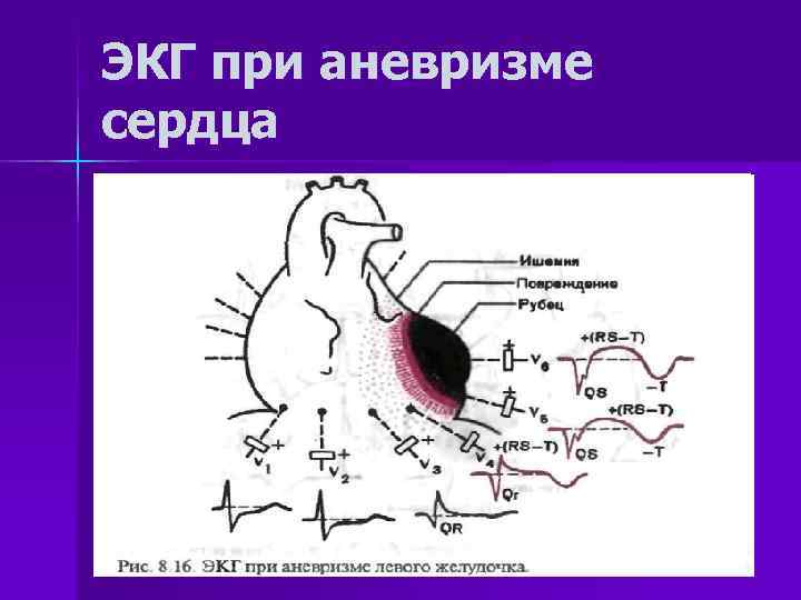 ЭКГ при аневризме сердца 