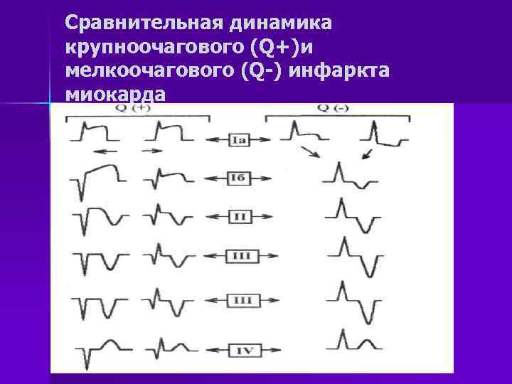 Сравнительная динамика крупноочагового (Q+)и мелкоочагового (Q-) инфаркта миокарда 