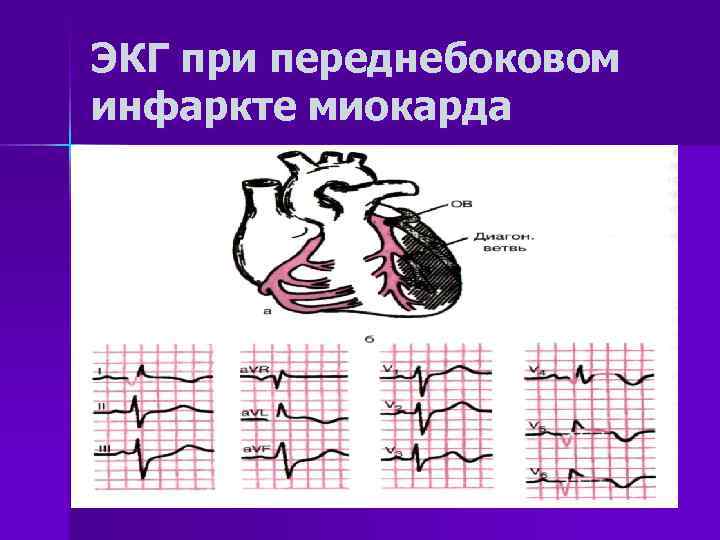 Передняя стенка лж