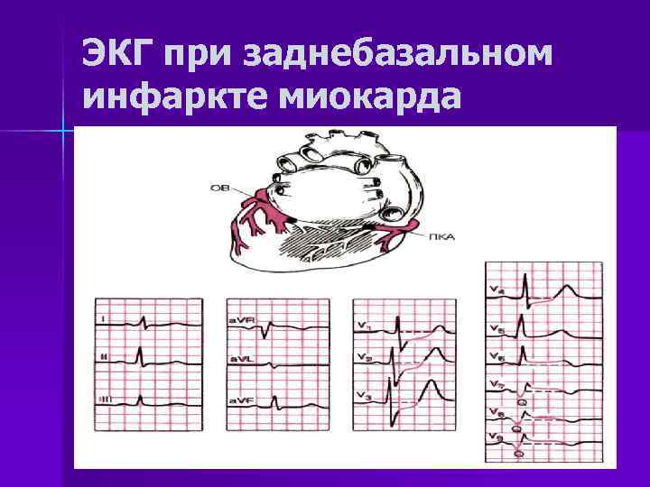 ЭКГ при заднебазальном инфаркте миокарда 