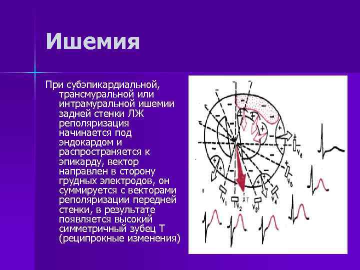 Ишемия При субэпикардиальной,  трансмуральной или  интрамуральной ишемии  задней стенки ЛЖ 