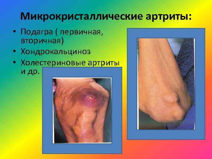  Микрокристаллические артриты:  • Подагра ( первичная,  вторичная) • Хондрокальциноз • Холестериновые