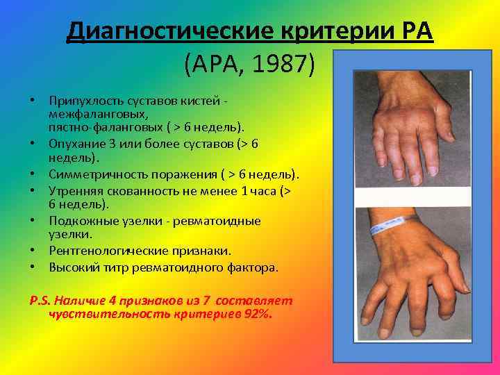  Диагностические критерии РА   (АРА, 1987) • Припухлость суставов кистей - 