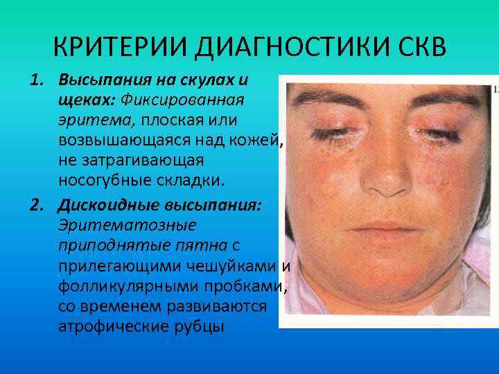  КРИТЕРИИ ДИАГНОСТИКИ СКВ 1. Высыпания на скулах и  щеках: Фиксированная  эритема,