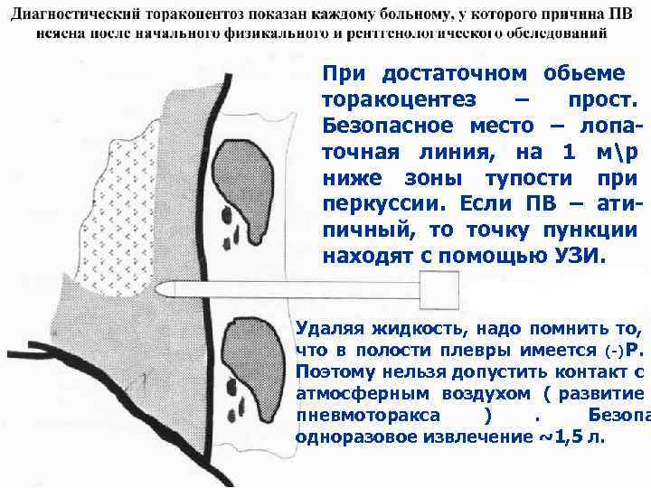 При достаточном обьеме  торакоцентез  –  прост.  Безопасное место –