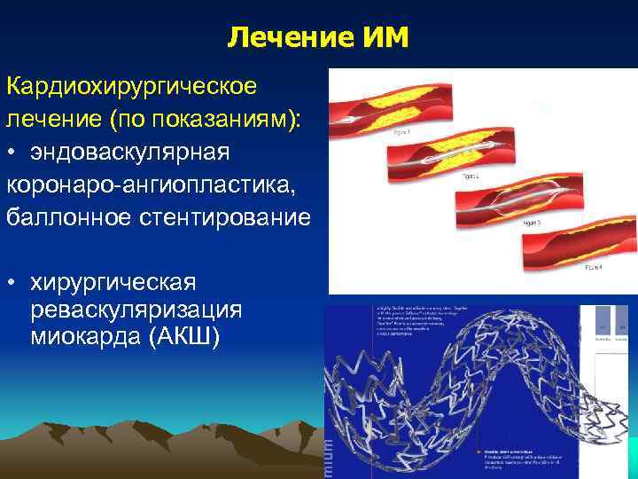    Лечение ИМ Кардиохирургическое лечение (по показаниям):  • эндоваскулярная коронаро-ангиопластика, баллонное